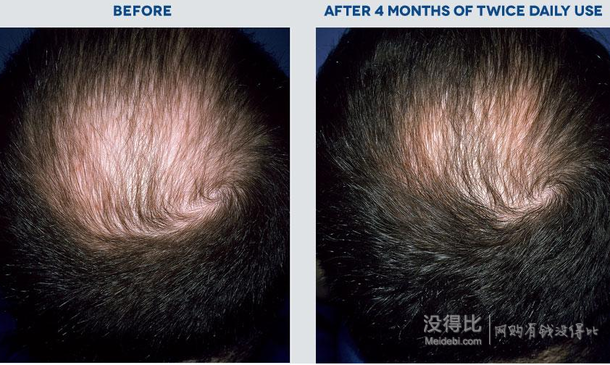 Rogaine 落健 Hair Regrowth Treatment 男用生发泡沫（60g*3支）